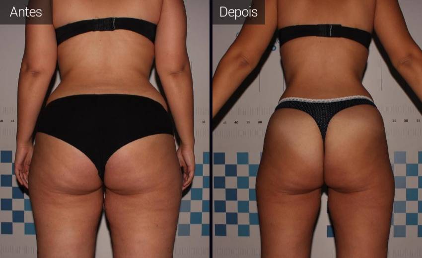 resultados - coxa - culote - vista posterior
